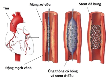 Can thiệp mạch vành qua da: Những thông tin cần biết