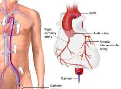 Chụp động mạch vành qua da: Những điều cần biết