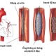 Can thiệp mạch vành qua da: Những thông tin cần biết