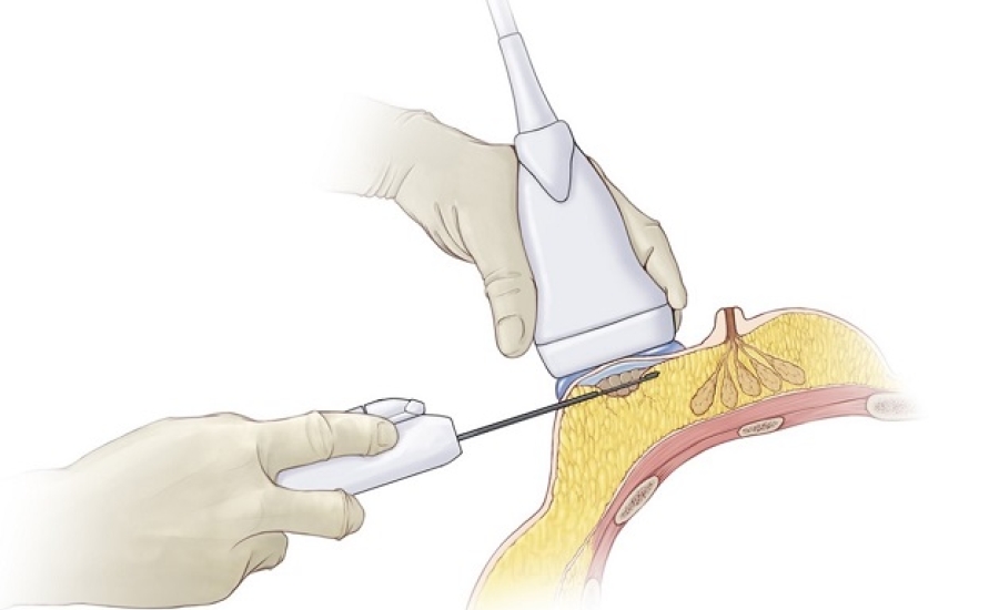 Sinh thiết vú có hỗ trợ hút chân không dưới hướng dẫn siêu âm: Những thông tin cần biết