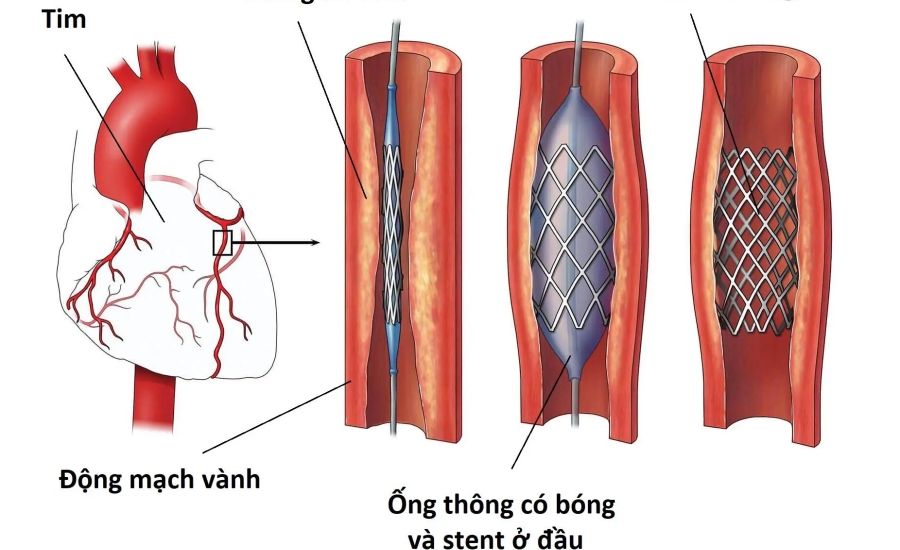Can thiệp mạch vành qua da: Những thông tin cần biết