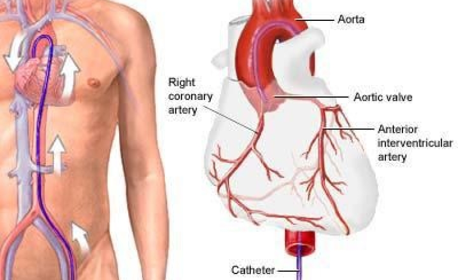 Chụp động mạch vành qua da: Những điều cần biết