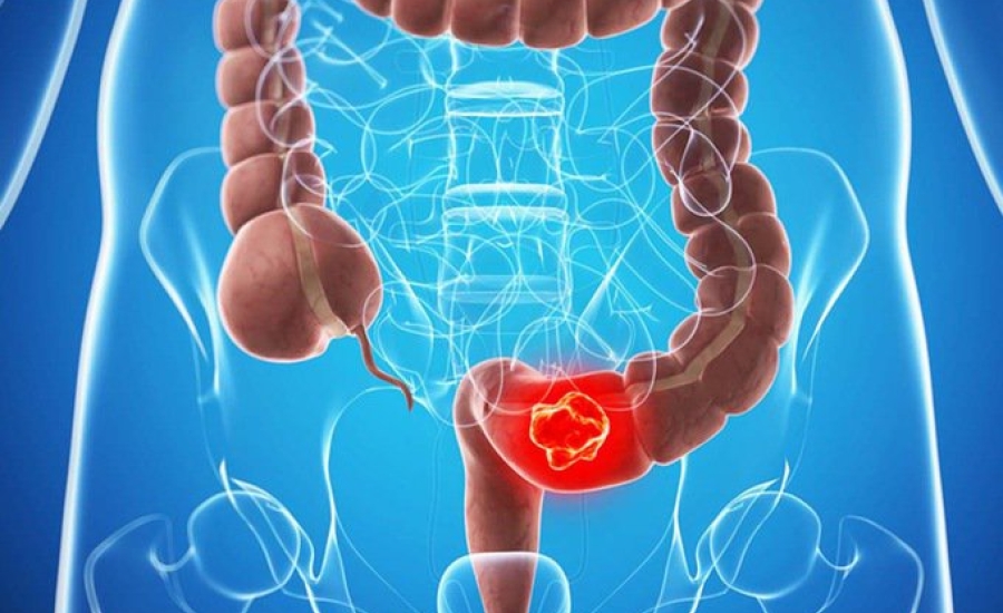 Ung thư đại trực tràng ở người cao tuổi: Nguyên nhân sinh bệnh và phương pháp điều trị
