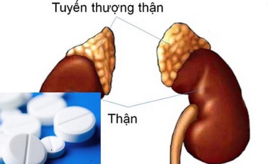 Suy thượng thận do thuốc Corticoid có thể chữa khỏi không?